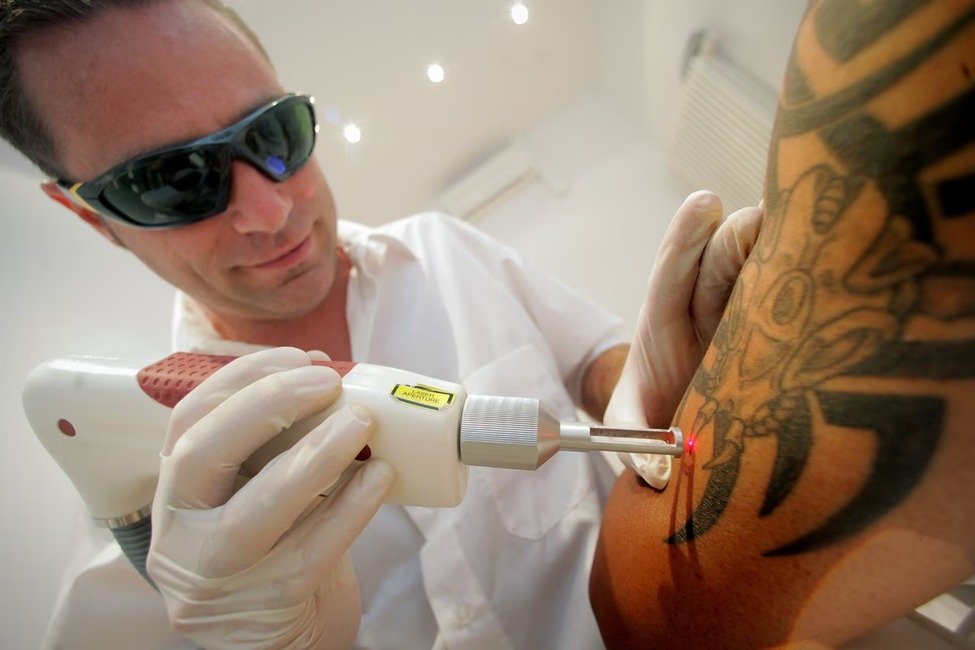 Fast and Painless: The Latest Tattoo Laser Removal Techniques in the USA